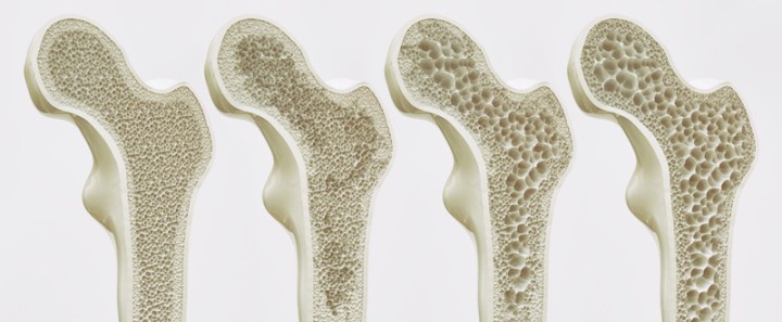 Is Osteoporosis a Disability?