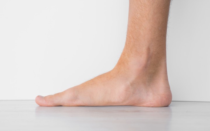 VA Disability for Flat Feet: The Essentials Facts About a VA Rating