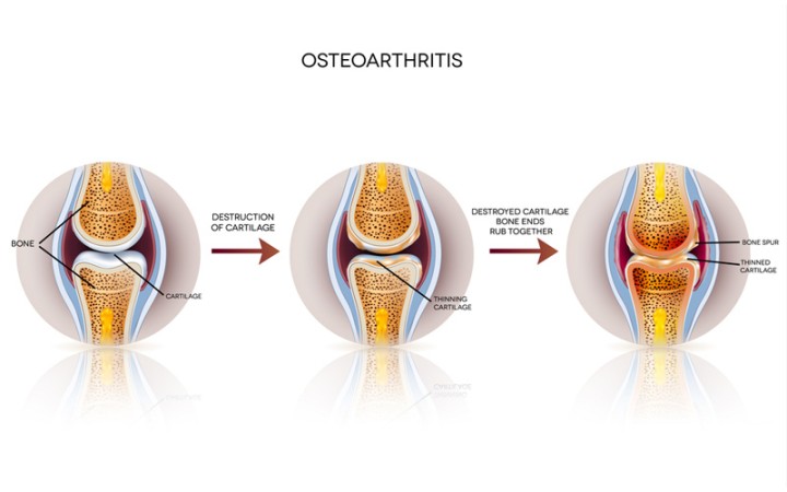 What Veterans Need to Know About Osteoarthritis?